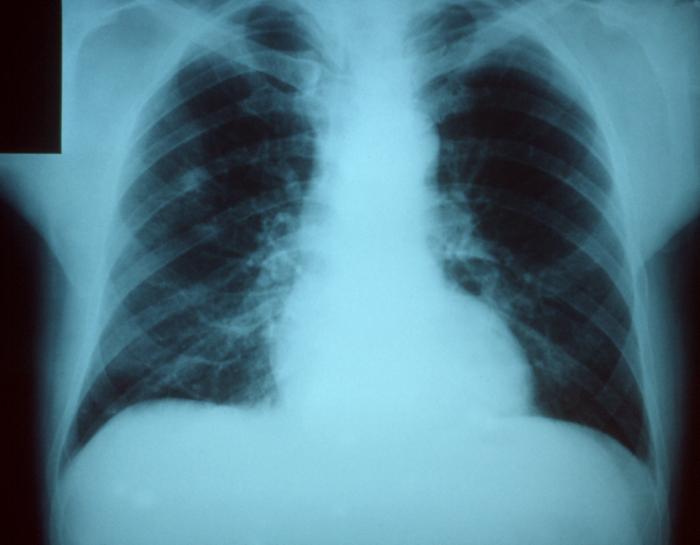 폐렴 환자의 흉부 X-ray